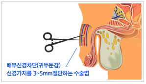 배부신경차단(귀두돈갑) 신경가지를 3~5mm절단하는 수술법 일러스트