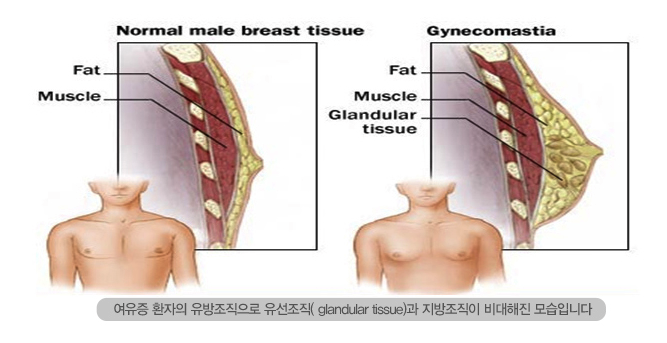 정상 남성 유방 조직(Normal male breast tissue)과 여유증(Gynecomastia) 비교 의료 일러스트 - 여유증 환자의 유방조직으로 유선조직(glandular tissue)과 지방조직이 비대해진 모습