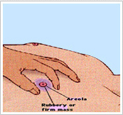 여유증 자가진단 손 일러스트 - Rubbery or firm mass / Areola 표기