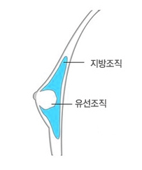 STEP 1 우성형유방 - 지방조직과 유선조직 도해