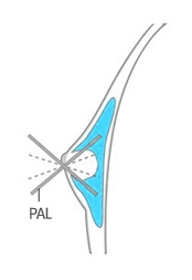 STEP 3 PAL 지방흡입술 도해